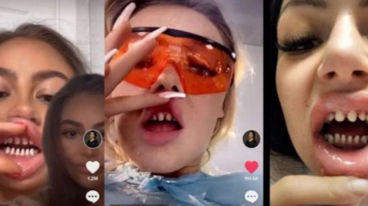 Zobārsti kritizē «TikTok» trendu, kurā jaunieši novīlē savus zobus