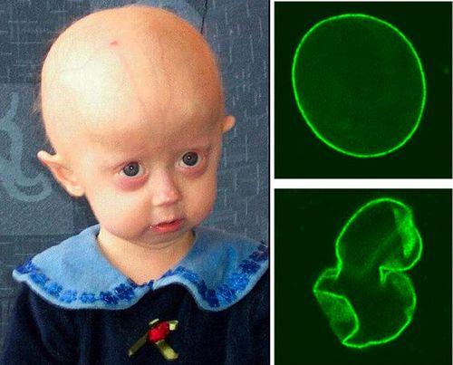 Progeria Šī ir fatāla... Autors: linkin12 Dīvaini sindromi un simptomi