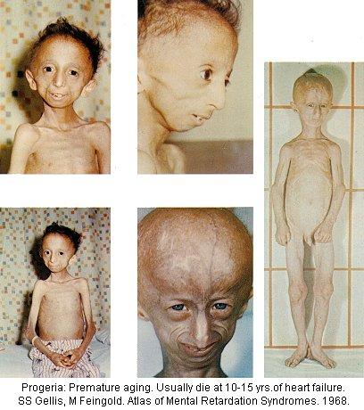 Slimība rodas mutāciju... Autors: Fosilija Progeria - Mirsti Jauns!