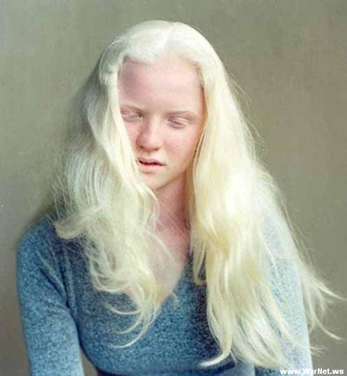 Cilvēkiem ar albīnismu parasti... Autors: agonywhispers albīnisms..