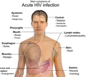  Autors: MaJIuHka Hiv/aids