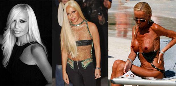 Donatella Versace Pirms un Pēc Autors: teadors5 Slavenības kurām nav paveicies