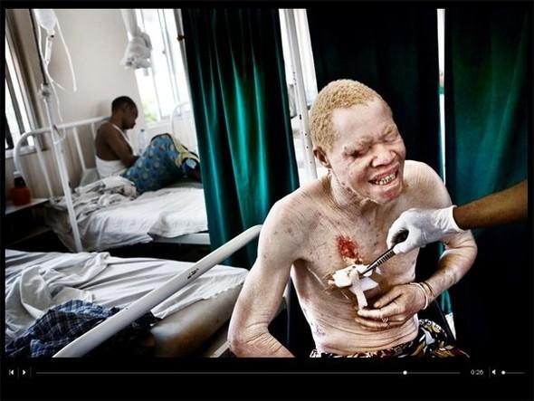 Tikai pēdējā laikā Tanzānijā... Autors: marju6ka Āfrikas albīni