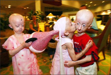 Progeriaslimībakuru izraisa... Autors: SutinersBoss Dīvainākās slimības uz pasaules