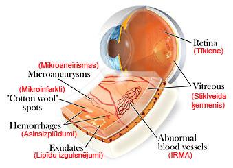 Tīklene ir acs iekšējais... Autors: roberts1144 Tīklenes patoloģija