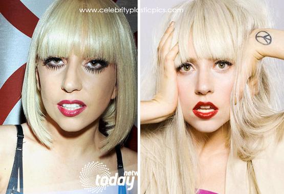 Lady Gaga arī samazināja... Autors: Simkiwi Slavenības, kuras nemanot veica plastiskās operācijas