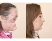 Pagājušajā gada decembrī... Autors: FoxxH Ārsti sievietei izveido jaunu seju.