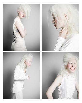 Tikai no mūsu cilvēciskā... Autors: brille121 Vai ir viegli būt albīnam?