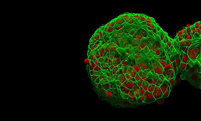 Krūts vēža šūna Autors: peleejums Makro-spoks