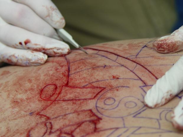 scarification