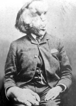 Joseph Merrick cilvēkszilonis... Autors: Edgarinshs Dīvainākie pasaules cirka mākslinieki