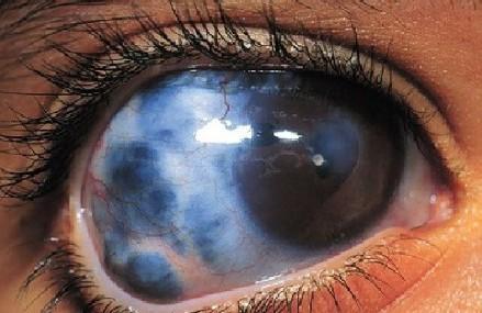 Glaukomair acu slimība... Autors: bubina696 Dažas izplatītākās acu slimības