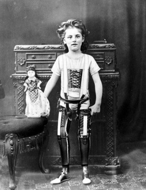 Maza meitenīte ar protēzēm... Autors: Uldis Siemīte 25 vēsturiski foto ,kuri aizsāk mūsdienas