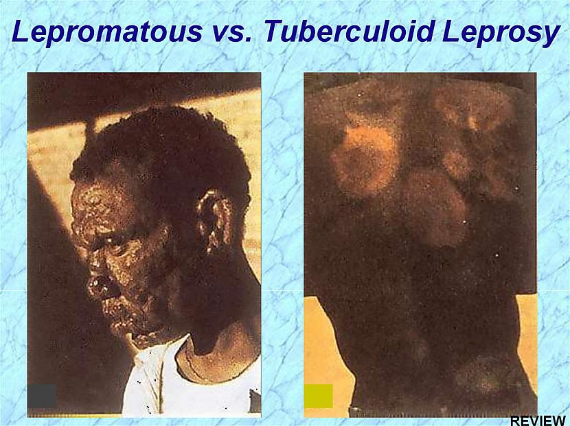Ārsti izscaronķir divas... Autors: Testu vecis Pasaules vecākā infekcijas slimība - Lepra jeb spitālība