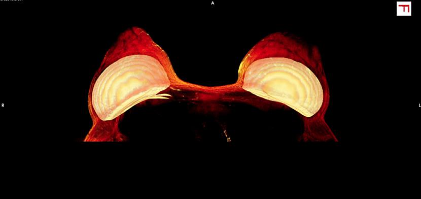 Krūscaronu implanti Uzņēmums... Autors: matilde 15 interesanti attēli, kuros redzamas dažādas cilvēka ķermeņa daļas