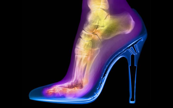 Pēda augstpapēžu apavāBritu... Autors: The Diāna 12 pārsteidzoši rentgeni, kuri liks uz pasauli raudzīties citādāk