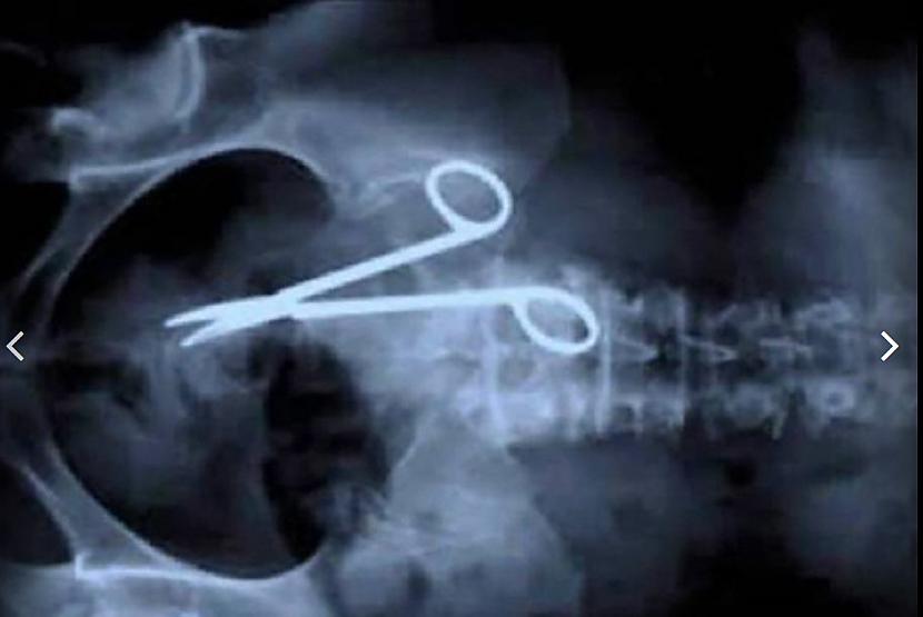 Ir reizes kad ķirurgi aizmirst... Autors: The Diāna 30 interesanti rentgeni. Vienkārši tāpat.
