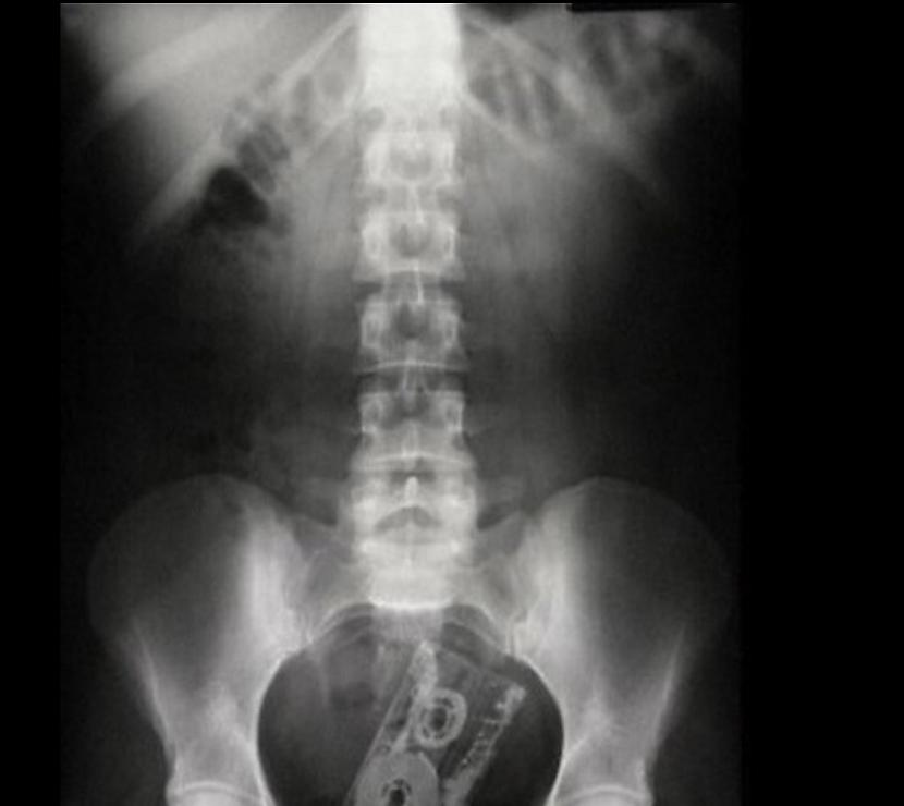 Ļoti līdzīgs rentgenuzņēmums... Autors: The Diāna 30 interesanti rentgeni. Vienkārši tāpat.