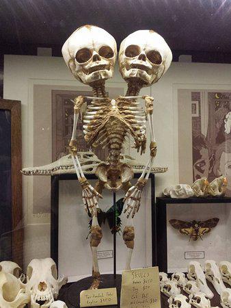 Siāmas dvīņu skelets Siāmas... Autors: The Diāna Izglītojoši: Neparasti skeleti, kuri ilustrē slimības un procesus