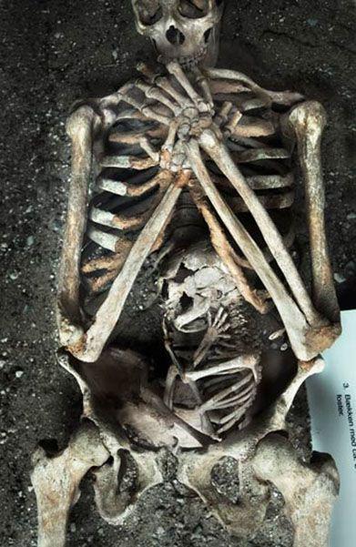 Grūtnieces skelets Autors: The Diāna Izglītojoši: Neparasti skeleti, kuri ilustrē slimības un procesus