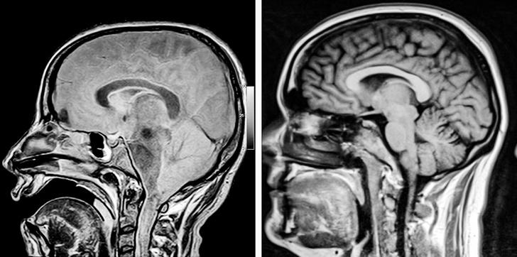 Tā izskatās normālas smadzens... Autors: Lestets 15 rentgenuzņēmumi, kas atklās par ķermeni vairāk nekā anatomijas grāmatas