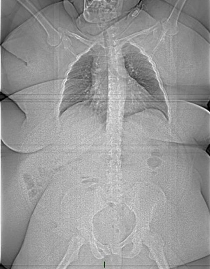 Pacients kurscaron sver 185 kg Autors: Lestets 15 rentgenuzņēmumi, kas atklās par ķermeni vairāk nekā anatomijas grāmatas