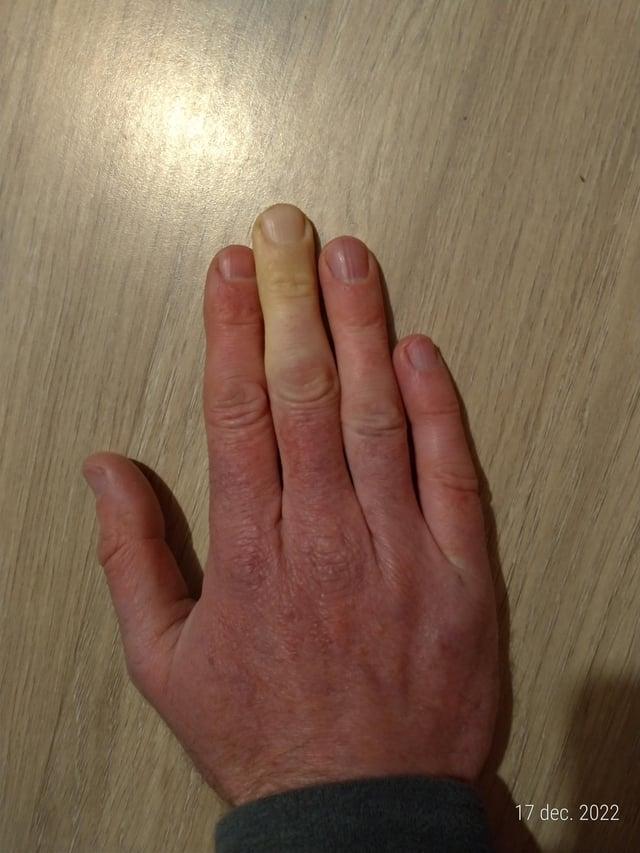 Man ir pirksts kas pastāvīgi... Autors: Zibenzellis69 18 dīvaini gadījumi, kad ģenētika pārsteidza un deva cilvēkiem neparastu izskatu